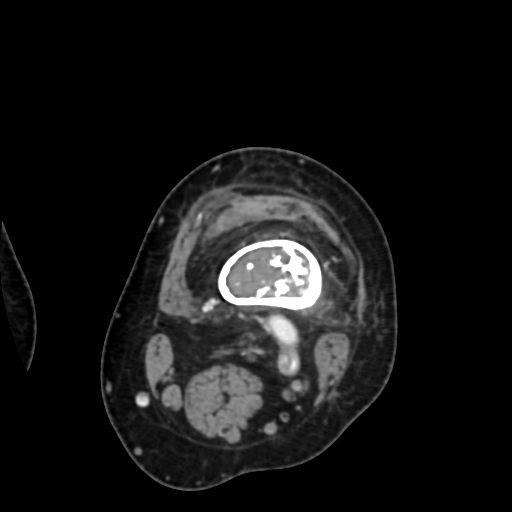 Chondrosarcoma - femur (Radiopaedia 64187-72954 Axial with contrast 25).jpg