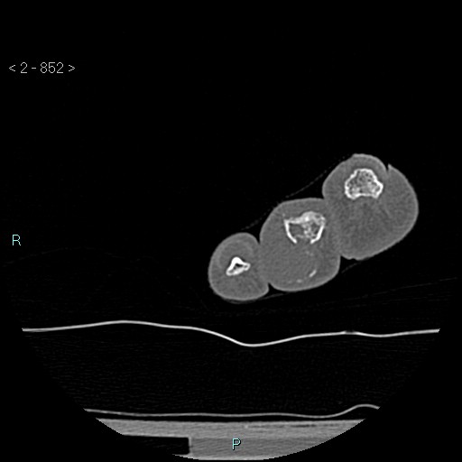 Chondrosarcoma - phalanx (Radiopaedia 69047-78812 Axial bone window 106).jpg