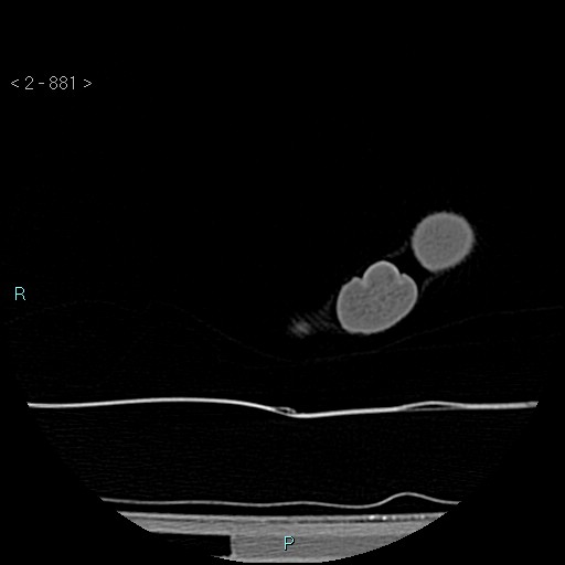 File:Chondrosarcoma - phalanx (Radiopaedia 69047-78812 Axial bone window 135).jpg