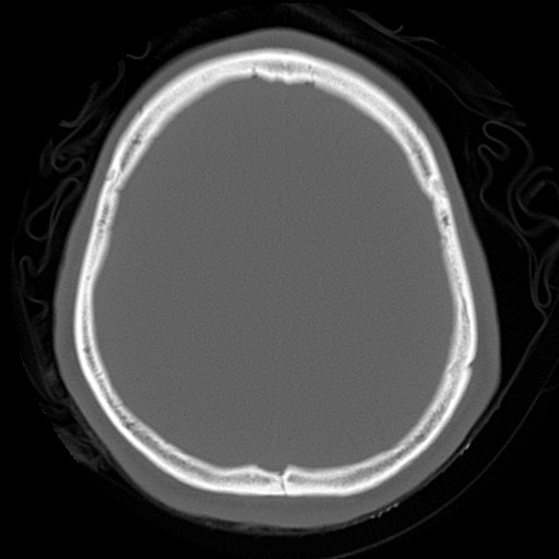 File:Chondrosarcoma - sphenoid wing (Radiopaedia 58259-67828 Axial bone window 21).jpg