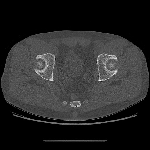 File:Chondrosarcoma of iliac wing (Radiopaedia 63861-72599 Axial bone window 93).jpg
