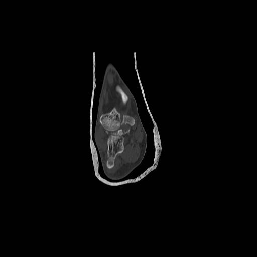 File:Chopart fracture (Radiopaedia 12386-12650 Coronal bone window 3).jpg