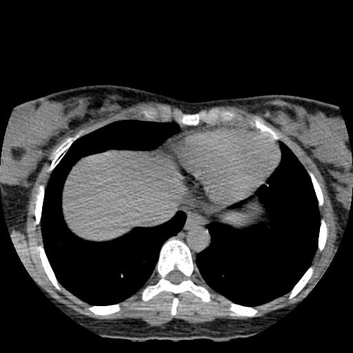 File:Choriocarcinoma of ovary with cerebral and pulmonary metastases (Radiopaedia 25983-26119 Axial non-contrast 23).jpg