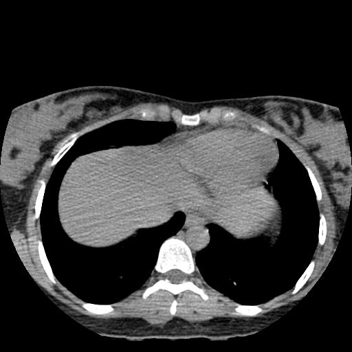 Choriocarcinoma of ovary with cerebral and pulmonary metastases (Radiopaedia 25983-26119 Axial non-contrast 25).jpg
