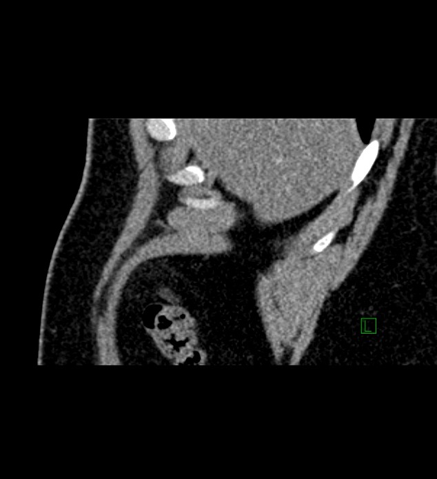 Chromophobe renal cell carcinoma (Radiopaedia 84286-99573 F 164).jpg