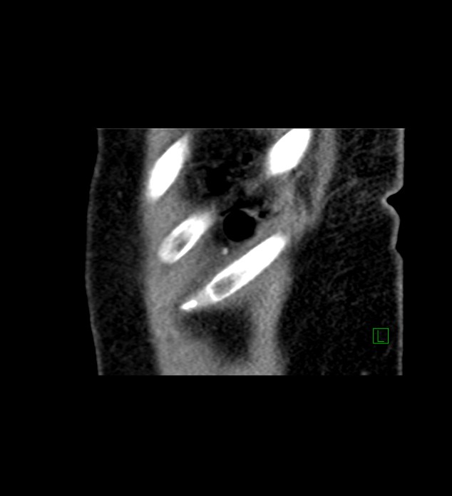 Chromophobe renal cell carcinoma (Radiopaedia 84290-99582 D 4).jpg
