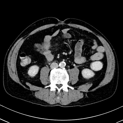 Chronic appendicitis complicated by appendicular abscess, pylephlebitis and liver abscess (Radiopaedia 54483-60700 B 86).jpg