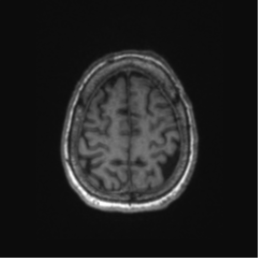 Chronic hypertensive encephalopathy (Radiopaedia 72844-83495 Axial T1 15).png
