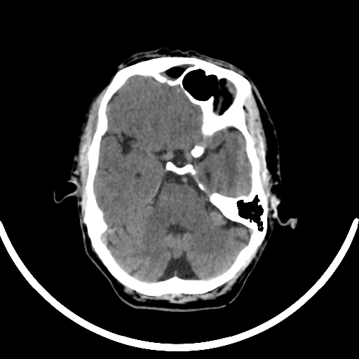 Chronic invasive fungal sinusitis with intraorbital and intracranial extension (Radiopaedia 56387-63046 Axial non-contrast 148).jpg