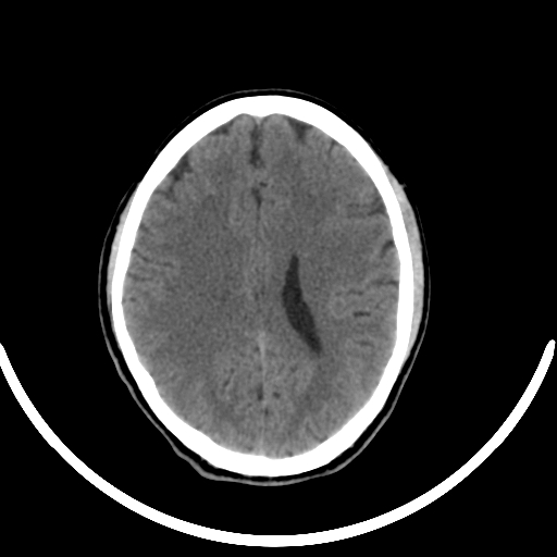 File:Chronic invasive fungal sinusitis with intraorbital and intracranial extension (Radiopaedia 56387-63046 Axial non-contrast 241).jpg