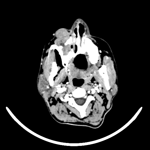 Chronic invasive fungal sinusitis with intraorbital and intracranial extension (Radiopaedia 56387-63046 B 9).jpg