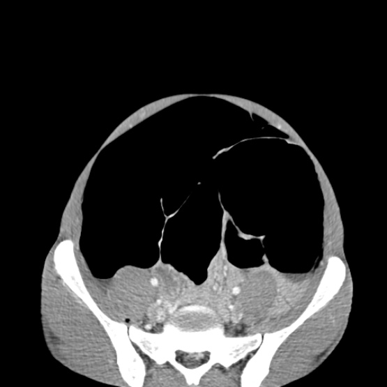Chronic large bowel pseudo-obstruction (Radiopaedia 43181-46492 A 128).jpg