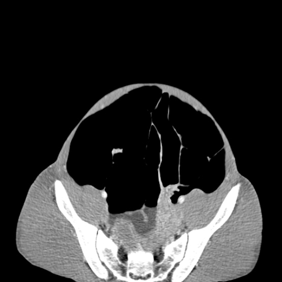 Chronic large bowel pseudo-obstruction (Radiopaedia 43181-46492 A 136).jpg