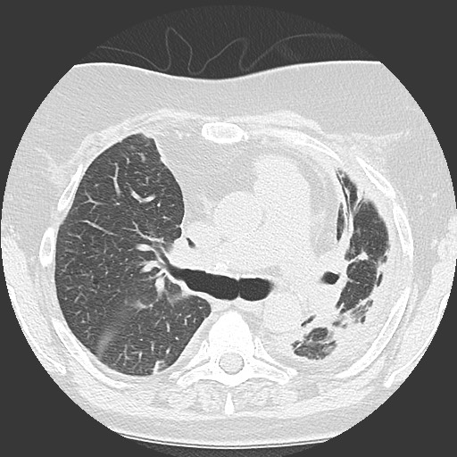 Chronic lung allograft dysfunction - restrictive form (Radiopaedia 60595-68316 Axial lung window 28).jpg