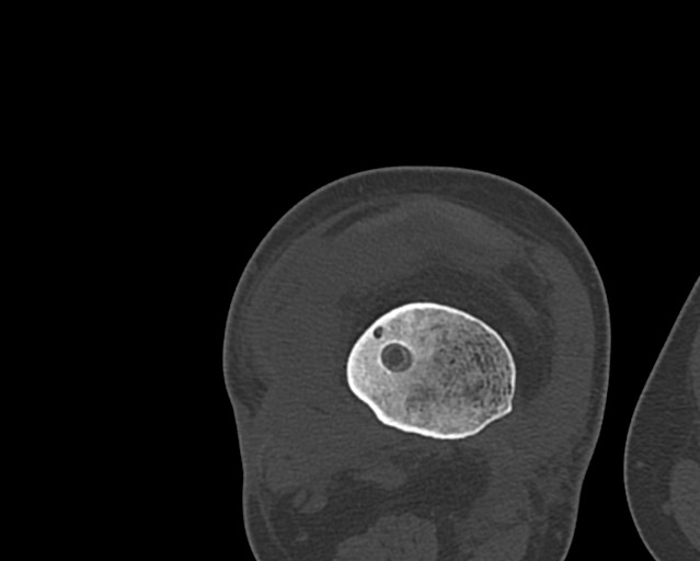 File:Chronic ostemyelitis of the femur with long sinus tract (Radiopaedia 74947-85982 Axial bone window 189).jpg
