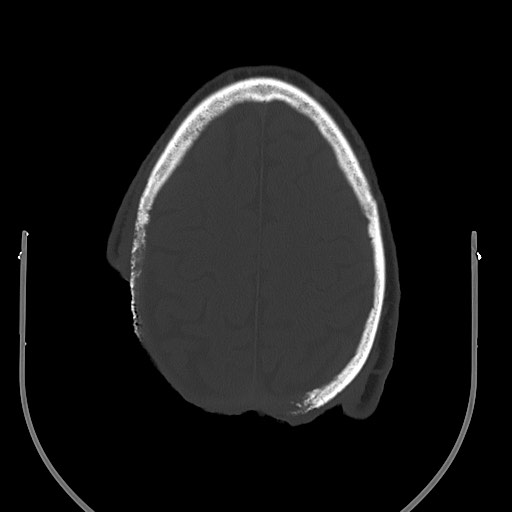 Chronic osteomyelitis - calvarial (severe) (Radiopaedia 69668-79616 Axial bone window 60).jpg