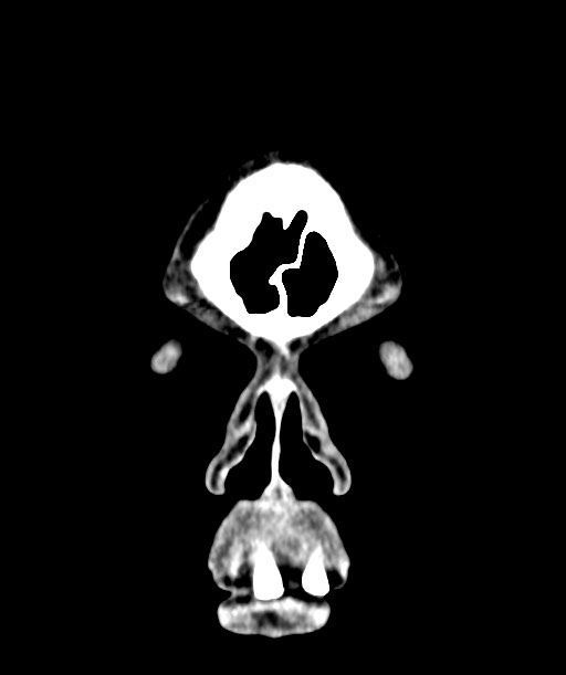 Chronic osteomyelitis - calvarial (severe) (Radiopaedia 69668-79616 Coronal non-contrast 7).jpg