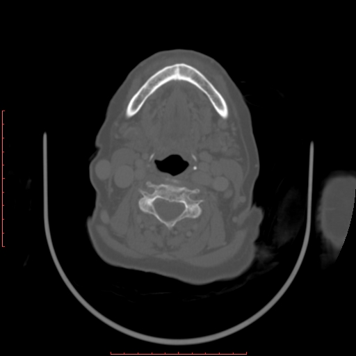 Chronic osteomyelitis - maxilla (Radiopaedia 23783-23927 Axial bone window 19).jpg