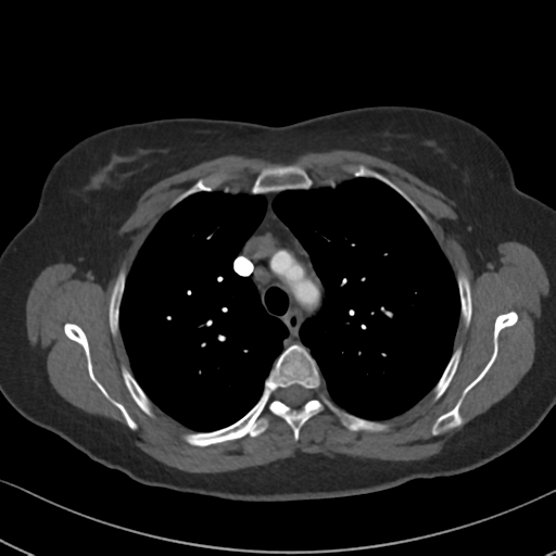 File:Chronic pulmonary embolus (Radiopaedia 39129-41341 Axial C+ CTPA 31).png