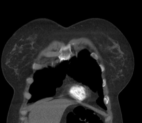 Chronic pulmonary embolus (Radiopaedia 39129-41341 Coronal C+ CTPA 16).png