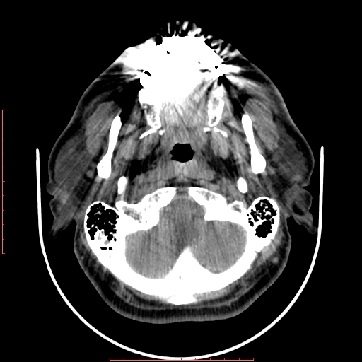 File:Chronic submandibular sialolithiasis (Radiopaedia 69817-79814 Axial non-contrast 41).jpg