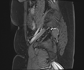 File:Class II Mullerian duct anomaly- unicornuate uterus with rudimentary horn and non-communicating cavity (Radiopaedia 39441-41755 G 9).jpg