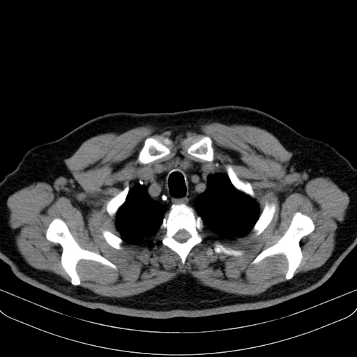 File:Classic complicated silicosis (Radiopaedia 49720-54961 Axial liver window 6).jpg