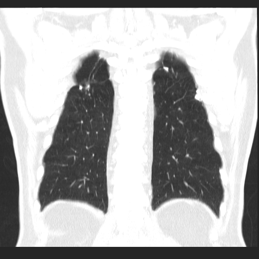 File:Classic complicated silicosis (Radiopaedia 49720-54961 Coronal lung window 51).jpg