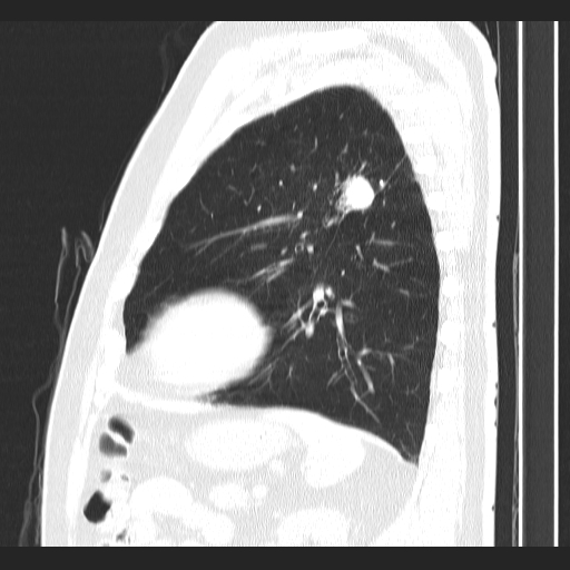 Classic complicated silicosis (Radiopaedia 49720-54961 Sagittal lung window 17).jpg