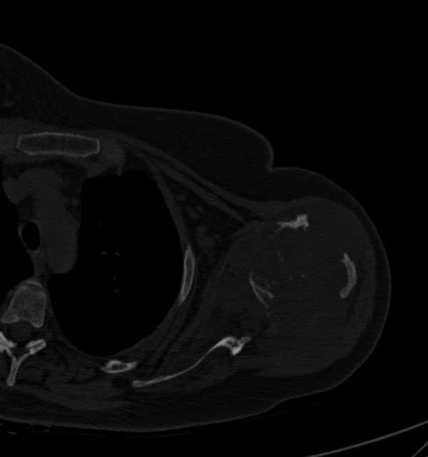 Clear cell chondrosarcoma - humerus (Radiopaedia 63104-71612 Axial bone window 48).jpg