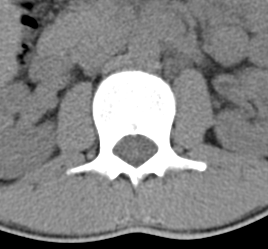 Clear cell meningoma - lumbar spine (Radiopaedia 60116-67691 Axial non-contrast 16).png