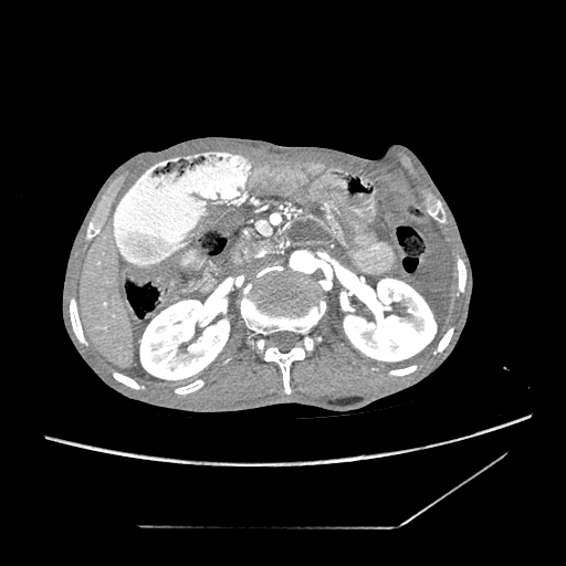 Closed-loop obstruction due to peritoneal seeding mimicking internal hernia after total gastrectomy (Radiopaedia 81897-95864 A 55).jpg