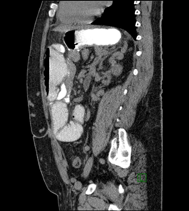 Closed-loop small bowel obstruction-internal hernia (Radiopaedia 78439-91096 C 61).jpg