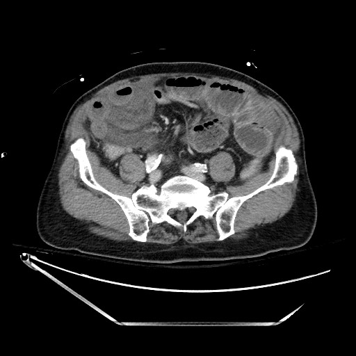 File:Closed loop obstruction due to adhesive band, resulting in small bowel ischemia and resection (Radiopaedia 83835-99023 D 108).jpg