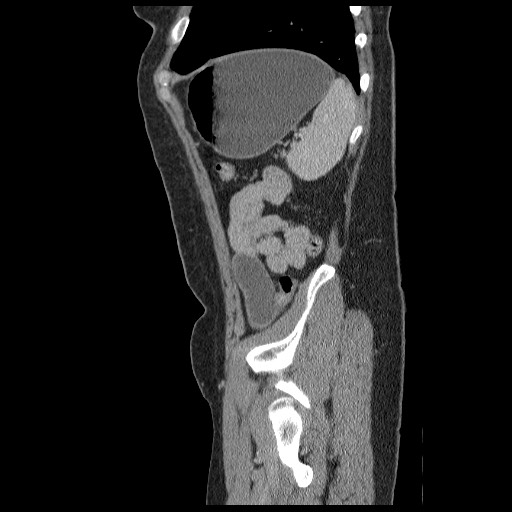 Closed loop small bowel obstruction (Radiopaedia 65403-74451 C 90).jpg