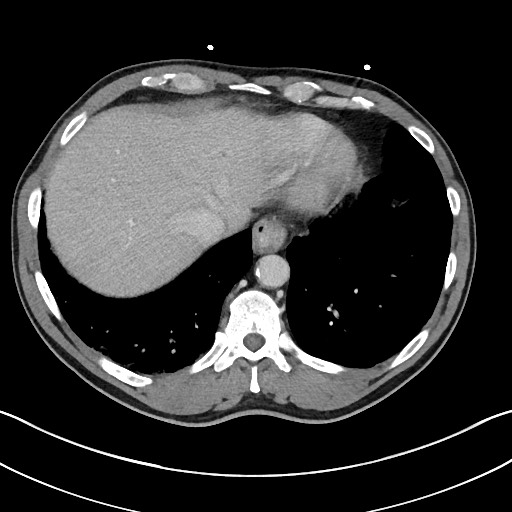 Closed loop small bowel obstruction - internal hernia (Radiopaedia 57806-64778 B 15).jpg
