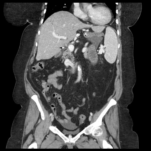 Closed loop small bowel obstruction - internal hernia (Radiopaedia 65402-74450 B 53).jpg