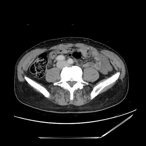 File:Closed loop small bowel obstruction - omental adhesion causing "internal hernia" (Radiopaedia 85129-100682 A 106).jpg