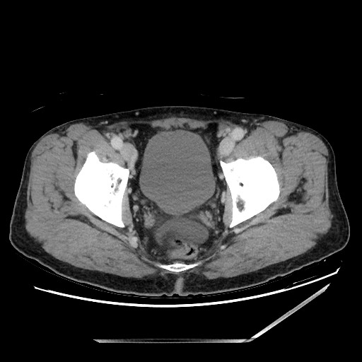 Closed loop small bowel obstruction - omental adhesion causing "internal hernia" (Radiopaedia 85129-100682 A 155).jpg
