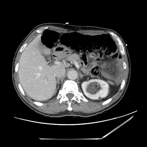 Closed loop small bowel obstruction - omental adhesion causing "internal hernia" (Radiopaedia 85129-100682 A 40).jpg