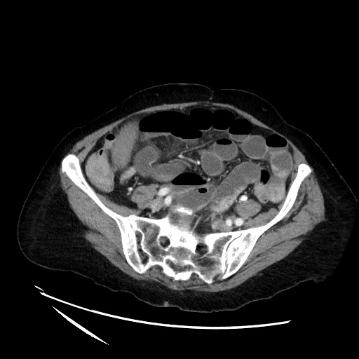File:Closed loop small bowel obstruction due to adhesive band, with intramural hemorrhage and ischemia (Radiopaedia 83831-99017 Axial 50).jpg