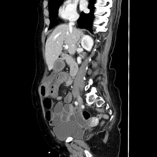 Closed loop small bowel obstruction due to adhesive band, with intramural hemorrhage and ischemia (Radiopaedia 83831-99017 D 88).jpg