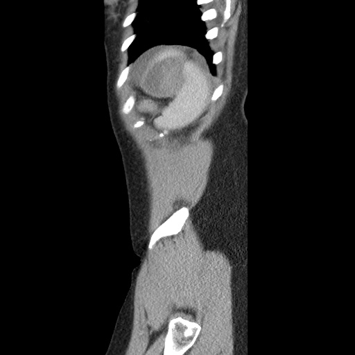 Closed loop small bowel obstruction due to trans-omental herniation (Radiopaedia 35593-37109 C 59).jpg