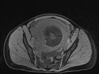 Closed loop small bowel obstruction in pregnancy (MRI) (Radiopaedia 87637-104031 F 48).jpg