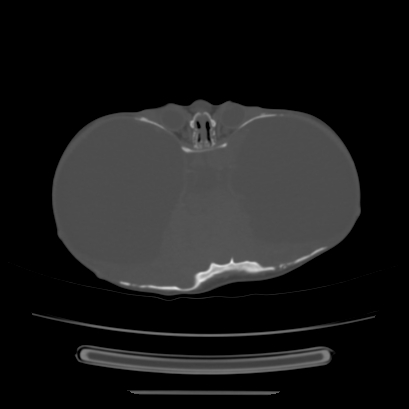 Cloverleaf skull (Radiopaedia 91901-109710 Axial bone window 71).jpg