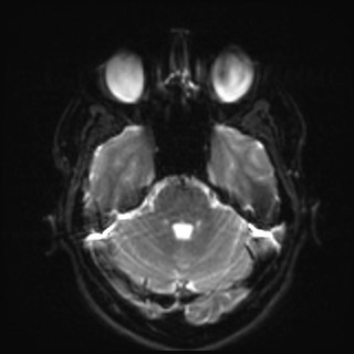 File:Cochlear incomplete partition type III associated with hypothalamic hamartoma (Radiopaedia 88756-105498 Axial DWI 12).jpg