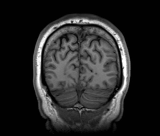 Cochlear incomplete partition type III associated with hypothalamic hamartoma (Radiopaedia 88756-105498 Coronal T1 13).jpg