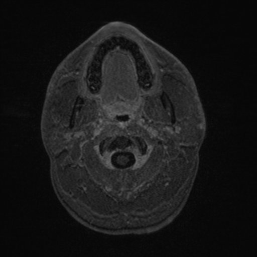 Colloid cyst (Radiopaedia 44510-48181 Axial T1 C+ 7).png