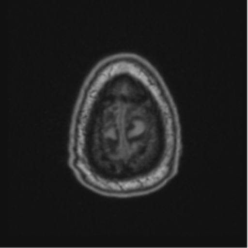 File:Colloid cyst of the third ventricle (Radiopaedia 86571-102662 Axial T1 72).png
