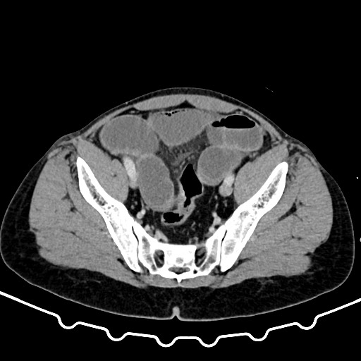 File:Colocolic intussusception due to large lipoma (Radiopaedia 68773-78482 A 158).jpg